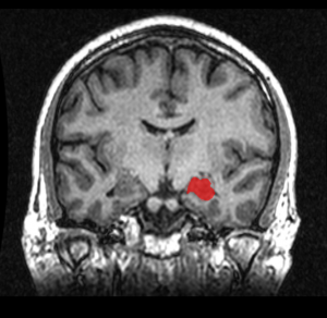 MRI_Location_Hippocampus_up